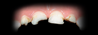 Лечение зуба под наркозом новосибирск