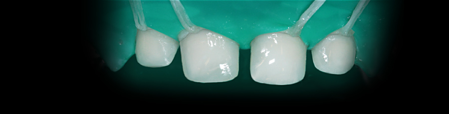 В новокузнецке лечение зубов под общим наркозом