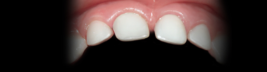 Лечение зуба под общим наркозом в новосибирске thumbnail