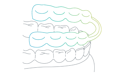 splint.png