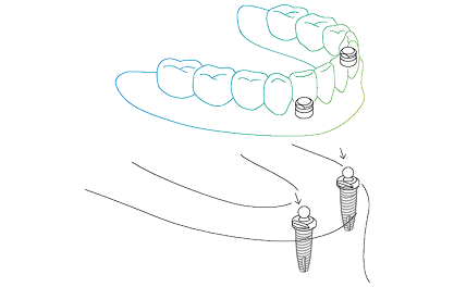 ball_protex_1.png